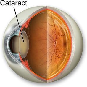 Cataract Surgery image