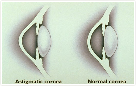 img-astigmatism