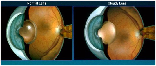 Comparison of eye lens with and without cataract – Detroit