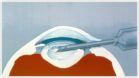 Strabismus Detroit - Crossed Eyes Rochester - Dr. Weingarten