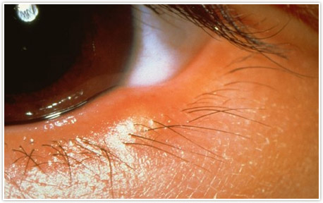 Detroit Chalazion Treatment