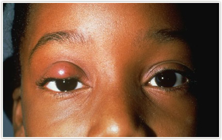 Detroit Chalazion Treatment