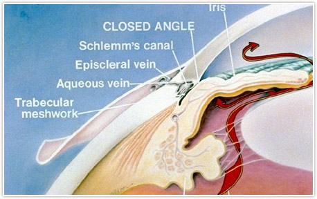 Closed Angle Glaucoma Treatment Detroit
