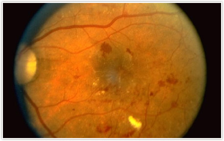 Diabetic Retinopathy Detroit