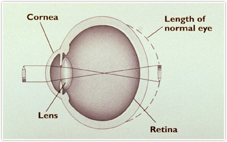 Farsightedness image