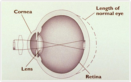 Farsightedness image