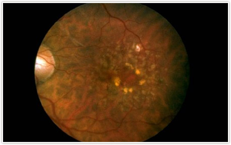 Detroit Macular Degeneration