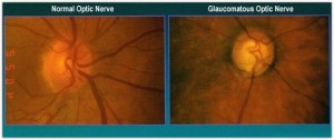 Glaucoma Treatment image