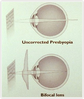 Detroit / Rochester Presbyopia