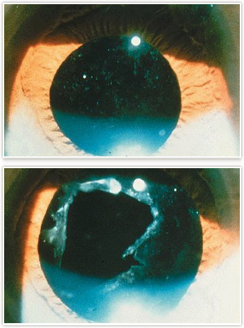 Strabismus Detroit - Crossed Eyes Rochester - Dr. Weingarten