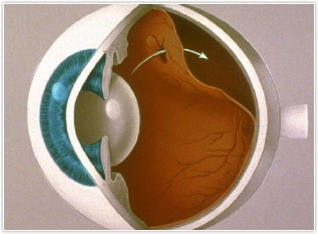 Strabismus Detroit - Crossed Eyes Rochester - Dr. Weingarten