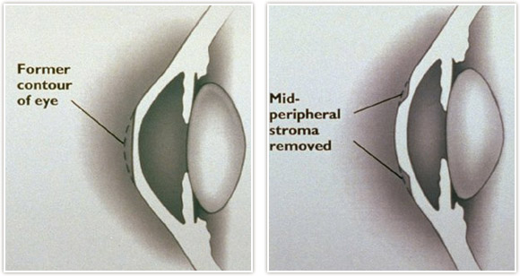 Laser Vision Correction Detroit